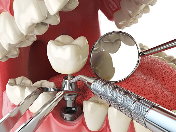 Best Emergency Root Canal Treatment in Spring Valley, NY